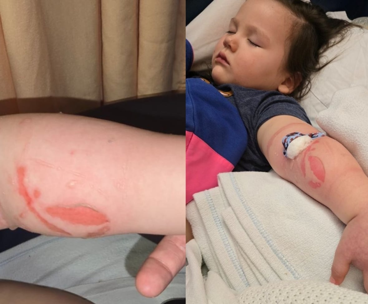 Winnipeg mom wants answers after toddler's IV led to swollen, blistered arm